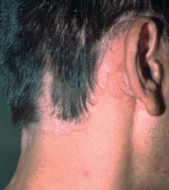 psoriasis scalp